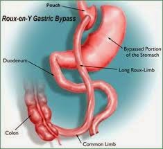 Bariatric Surgery – More Long Term, High Quality Data Needed