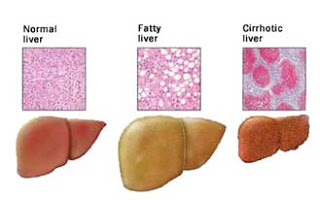 Does Exercise Improve Fatty Liver Disease?