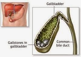 Why Weight Loss Increases Gallstone Risk