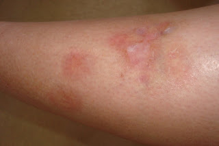 What Is That On My Legs? Necrobiosis Lipoidica Diabeticorum