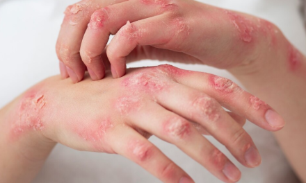 Could GLP1 weight loss/diabetes medications benefit skin conditions like psoriasis or hidradenitis suppurativa?